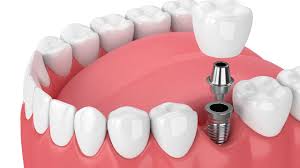 SMILE WAY DENTAL CARE MANJERI